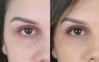 What to do after fillers under eyes?